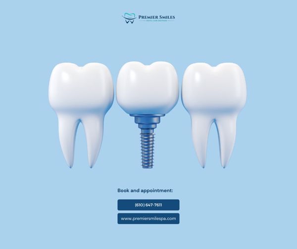 dental implants galerie 2